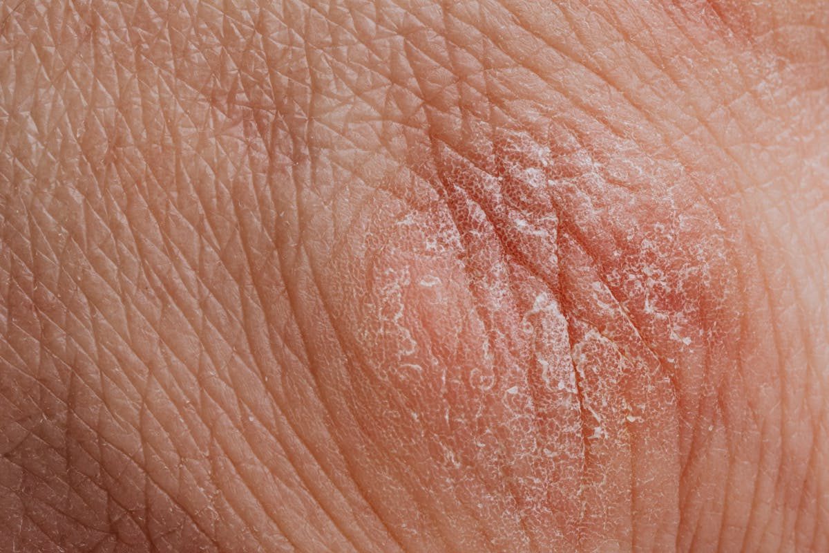 Detailed image highlighting dry, flaky skin texture for dermatological study.